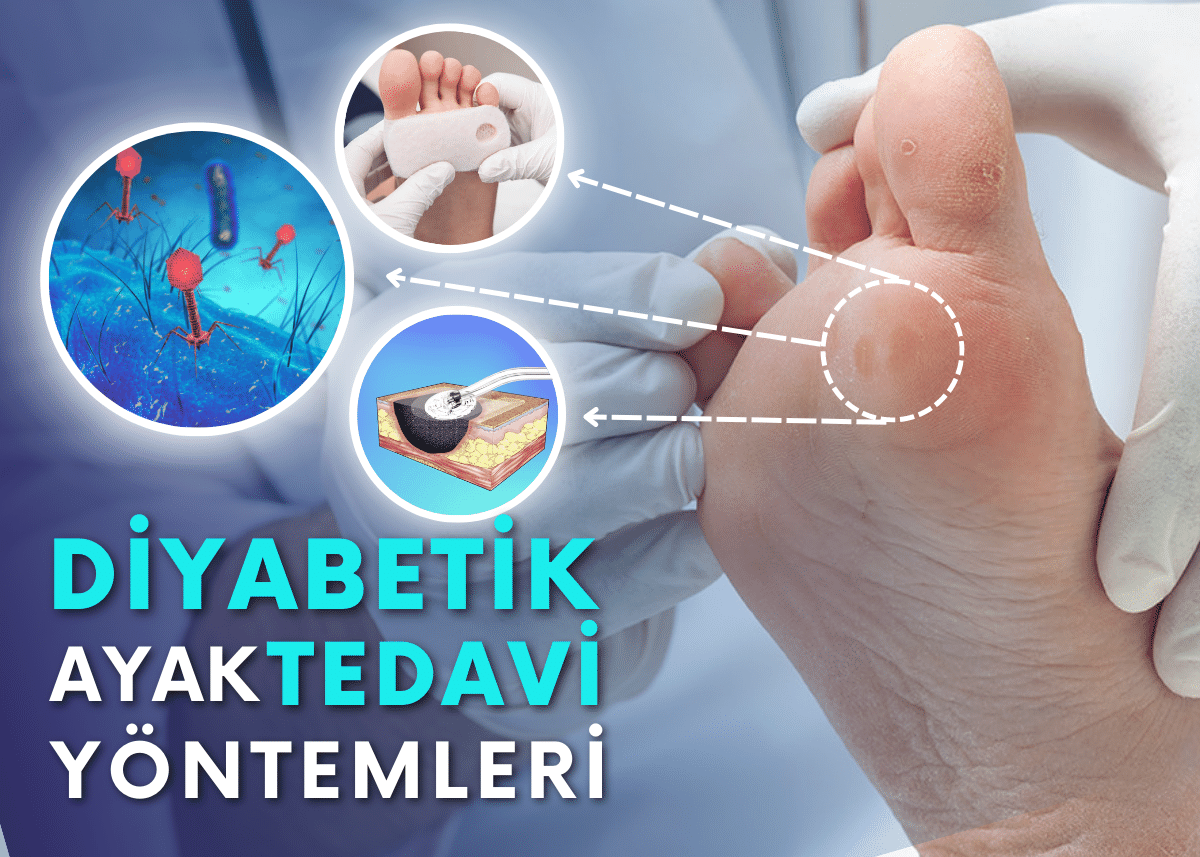 What is Diabetic Foot? Reasons? and Treatment Methods