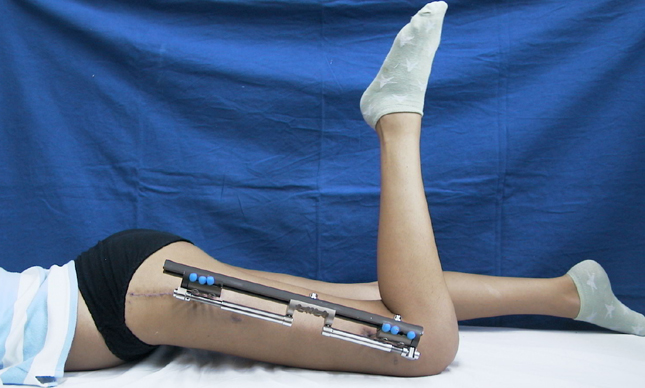 Height Increase Surgery: Ways to Achieve Your Height Goals