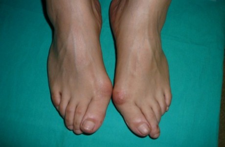 Хирургическое лечение Hallux Rigidus