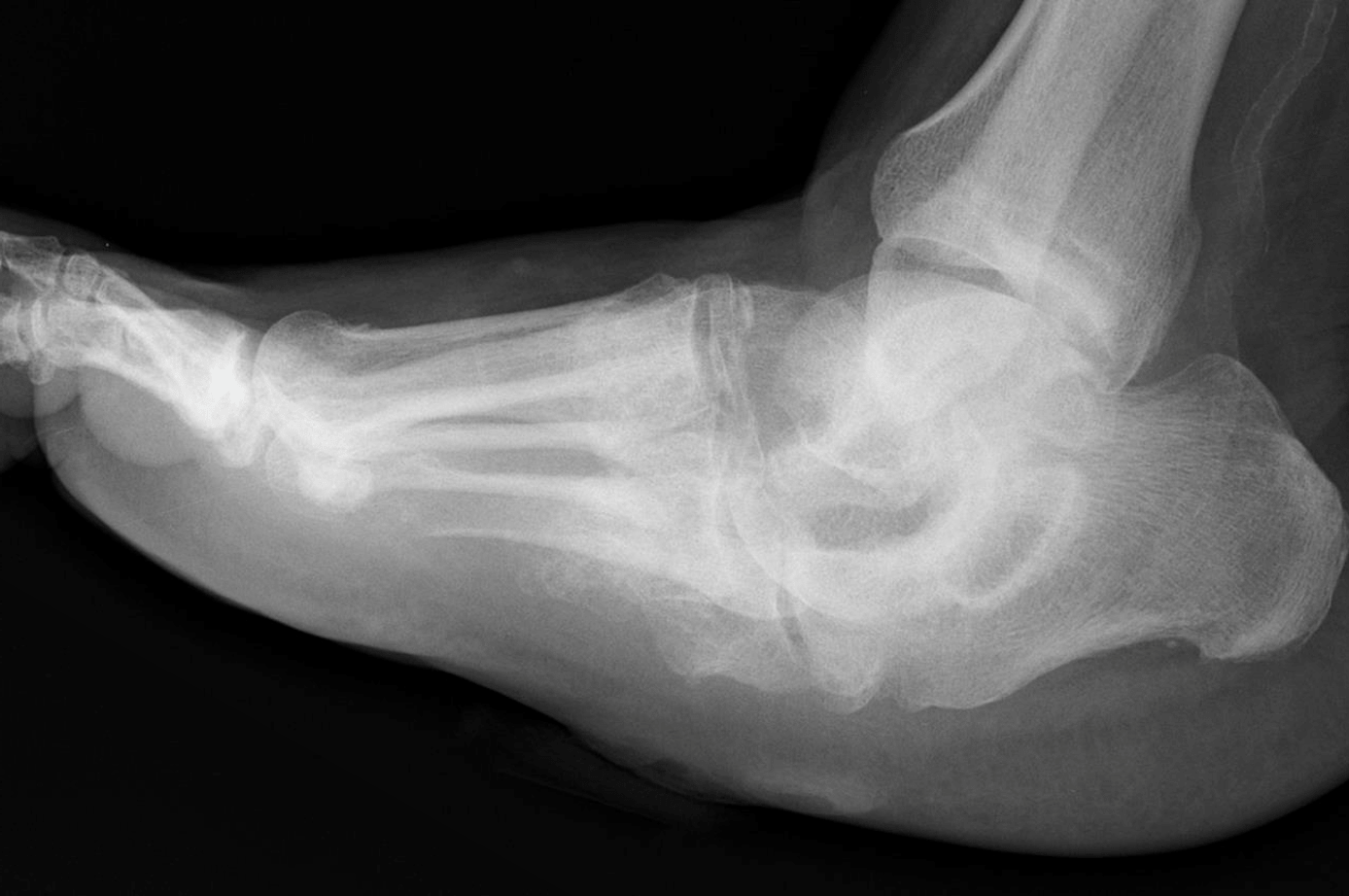 Charcot Foot Surgical Treatment