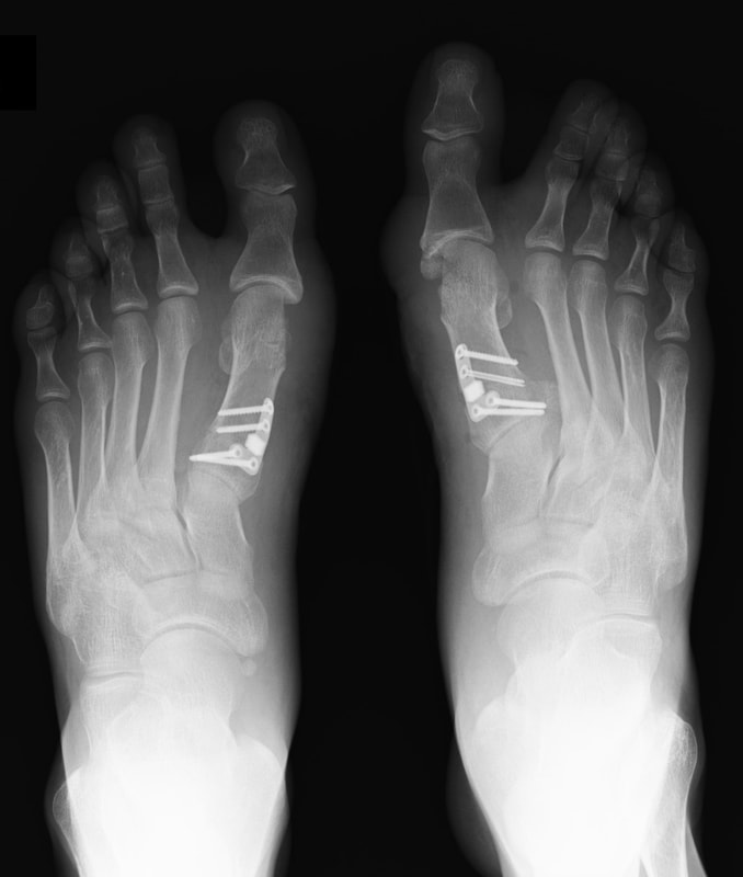 Хирургическое лечение Hallux Valgus