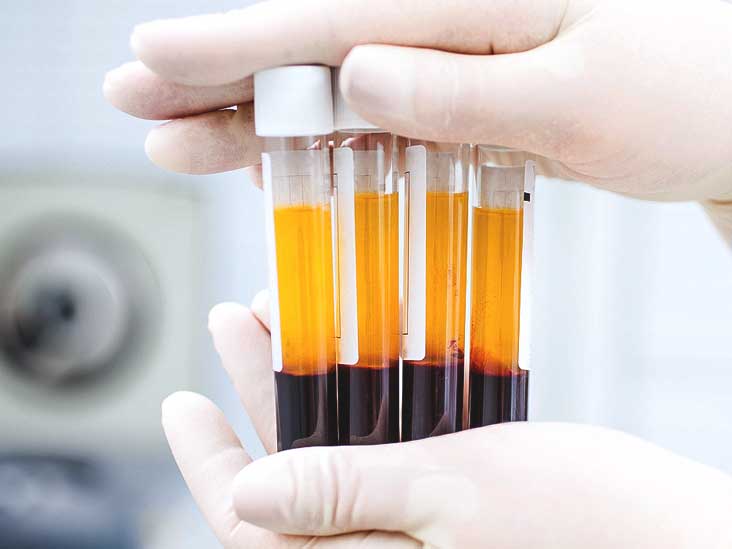 PRP (Platelet Rich Plasma)